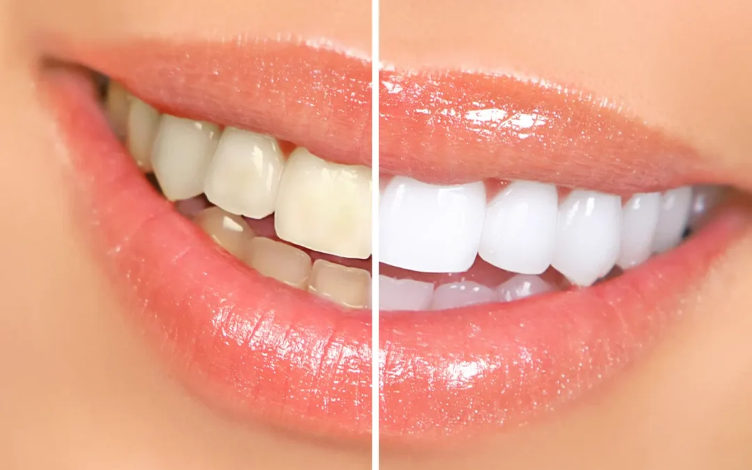 Maintaining Your Teeth Whitening Results: Tips from Redmond Dental Experts