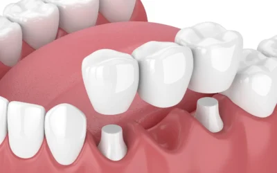How Are Dental Bridges Attached?