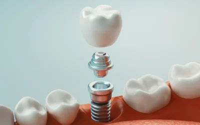 Beyond the Gap: Why Dental Implants Are the Superior Choice for Bone Health